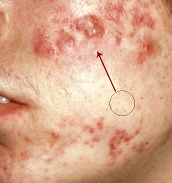 remove acne